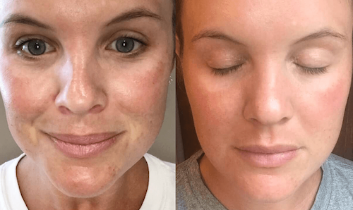 skin rejuvenation with plasma facial before after mississauga oakville